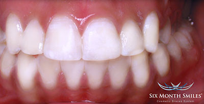 Transformasi Senyum- Global Estetik Dental Care