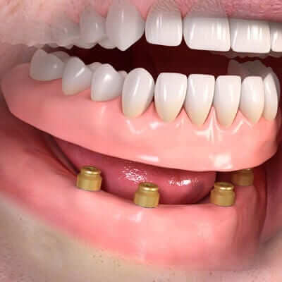 Dental Implants - removable denture with attachement