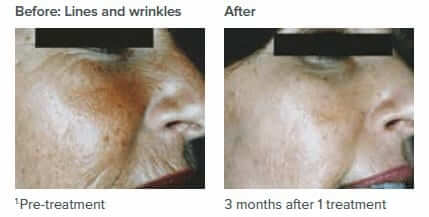 Anti-Wrinkle Treatment in Sutton Coldfield