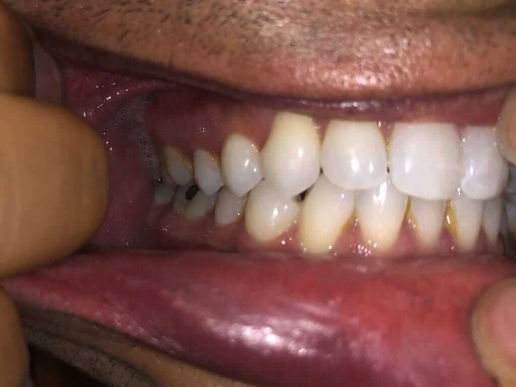 Right Teeth