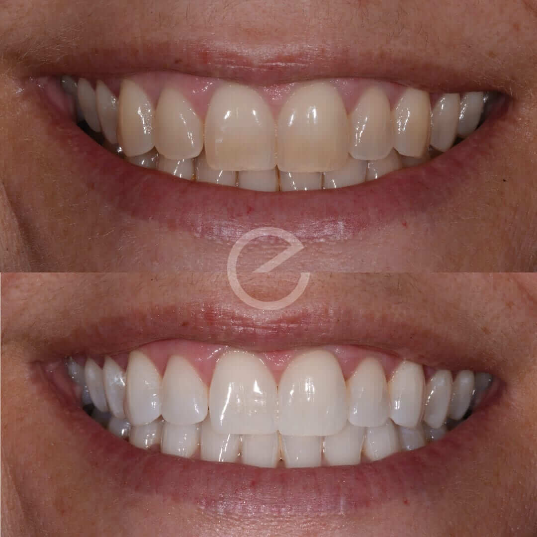 Teeth Whitening Treatment in Sutton Coldfield & Solihull