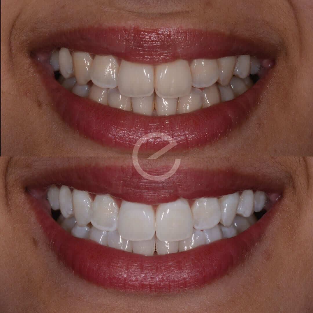 Teeth Whitening Treatment in Sutton Coldfield & Solihull