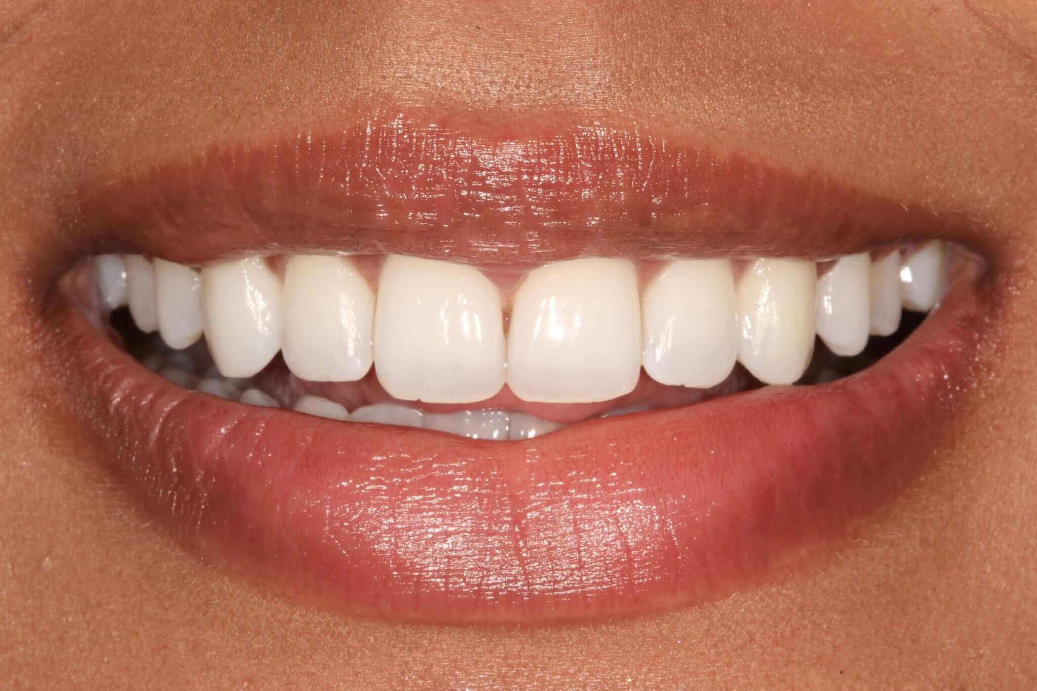 Invisalign Solihull and Birmingham